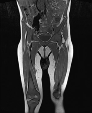 File:Neuroblastoma with bone metastases (Radiopaedia 67080-76414 Coronal T1 8).jpg
