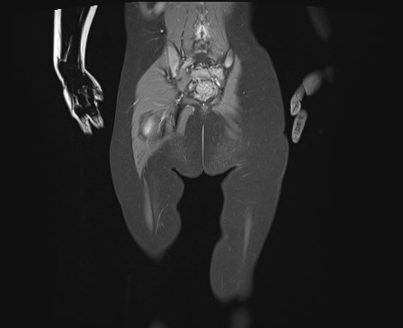 File:Neuroblastoma with bone metastases (Radiopaedia 67080-76414 E 22).jpg