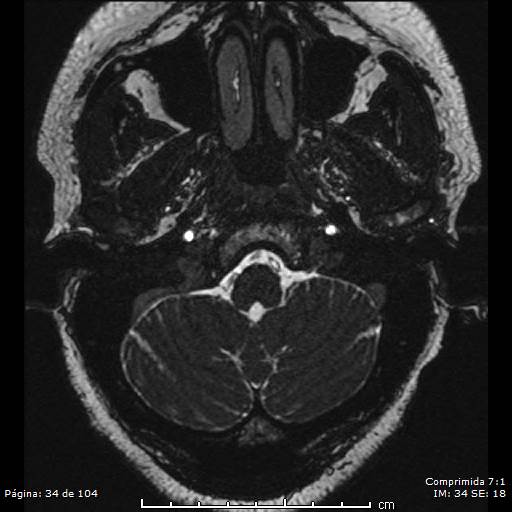 Neurocysticercosis (Radiopaedia 58636-65832 I 34).jpg