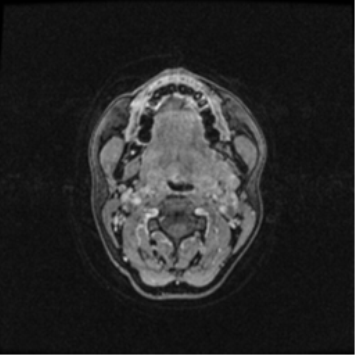 Neurofibromatosis type 2 (Radiopaedia 45229-49244 Axial T1 C+ 1).png