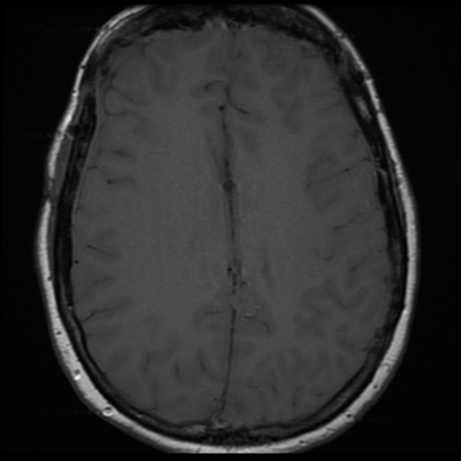 File:Neurofibromatosis type 2 (Radiopaedia 45229-49251 Axial T1 23).png