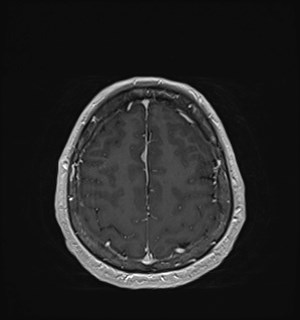 Neurofibromatosis type 2 (Radiopaedia 79097-92049 Axial T1 C+ 160).jpg