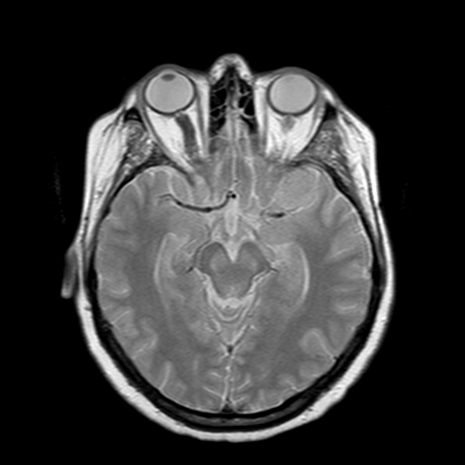 File:Neurofibromatosis type 2 (Radiopaedia 8713-9518 Axial Gradient Echo 15).jpg
