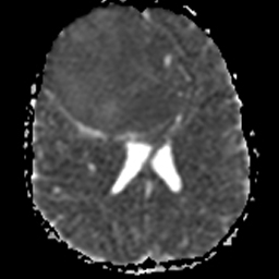 File:Neurofibromatosis type 2 (Radiopaedia 8953-9730 Axial ADC 1).jpg