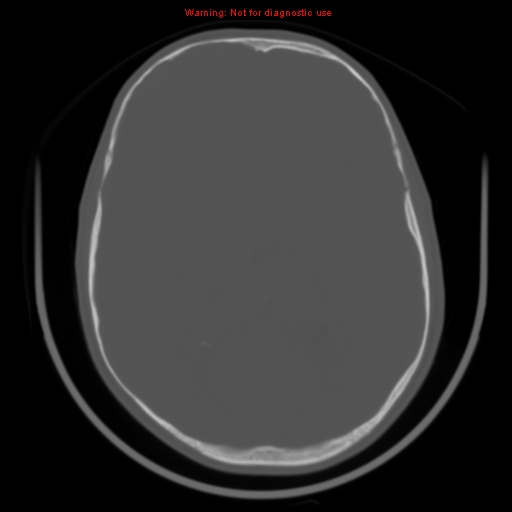 File:Neurofibromatosis type 2 (Radiopaedia 8953-9732 Axial bone window 20).jpg