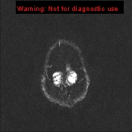 File:Neuroglial cyst (Radiopaedia 10713-11184 Axial DWI 1).jpg