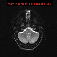 File:Neuroglial cyst (Radiopaedia 10713-11184 Axial DWI 18).jpg