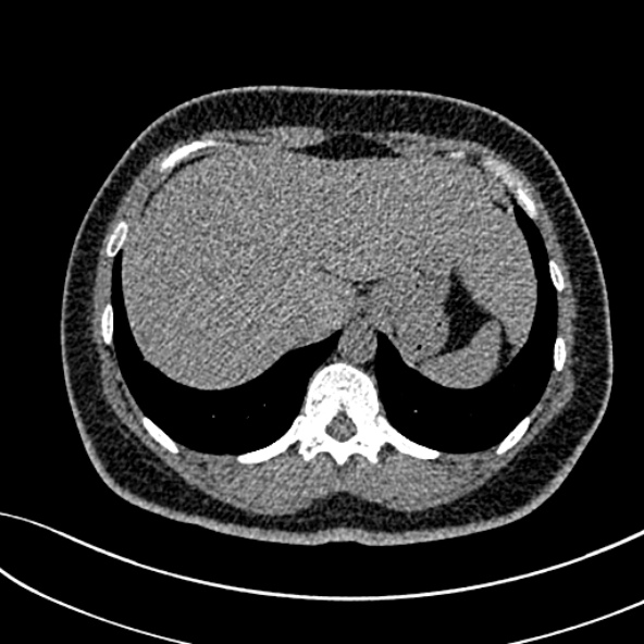 Normal CT chest- adult female (Radiopaedia 52522-58428 Axial non-contrast 114).jpg