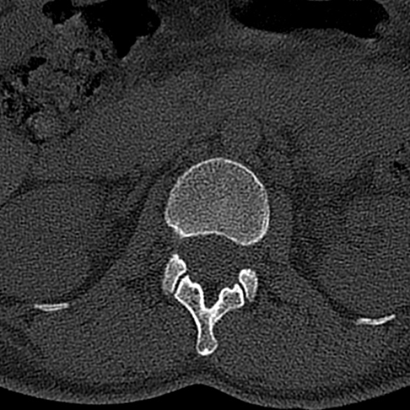 File:Normal CT lumbar spine (Radiopaedia 53981-60118 Axial bone window 19).jpg