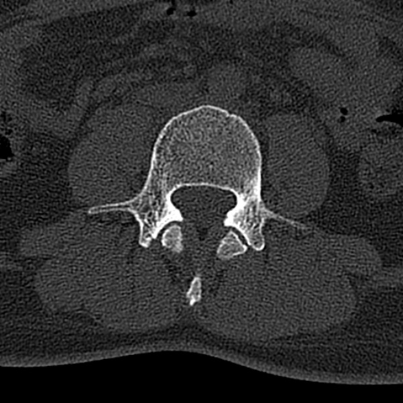 File:Normal CT lumbar spine (Radiopaedia 53981-60118 Axial bone window 44).jpg