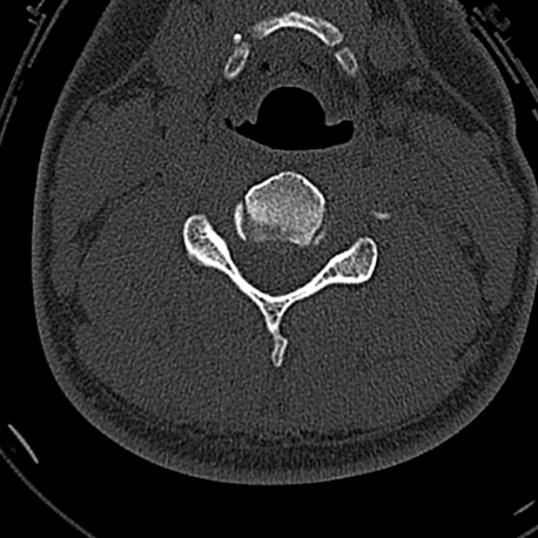 Normal CT of the cervical spine (Radiopaedia 53322-59305 Axial bone window 144).jpg