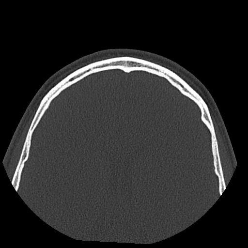 Normal CT paranasal sinuses (Radiopaedia 42286-45390 Axial bone window 9).jpg
