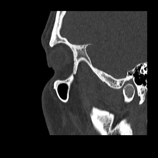 Normal CT paranasal sinuses (Radiopaedia 42286-45390 Sagittal bone window 10).jpg