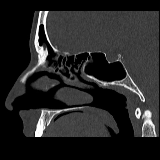 Normal CT paranasal sinuses (Radiopaedia 42286-45390 Sagittal bone window 47).jpg