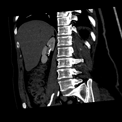 File:Normal CT renal artery angiogram (Radiopaedia 38727-40889 C 18).png