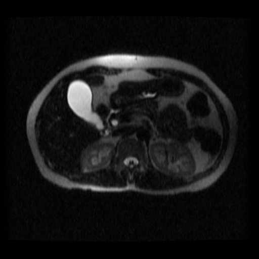 File:Normal MRCP (Radiopaedia 41966-44978 Axial T2 thins 18).png