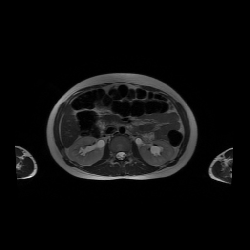 File:Normal MRI abdomen in pregnancy (Radiopaedia 88001-104541 Axial T2 25).jpg