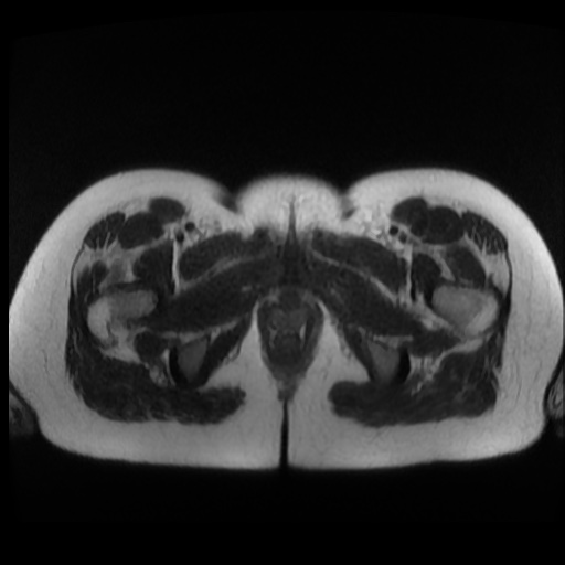 Normal MRI abdomen in pregnancy (Radiopaedia 88003-104546 Axial T2 52).jpg