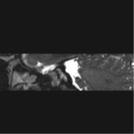 Normal MRI internal auditory canal (Radiopaedia 41613-44525 C 81).png