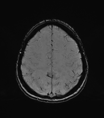 Normal brain MRI (TLE protocol) (Radiopaedia 40748-43405 Axial SWI 69).png