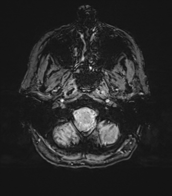 Normal brain MRI (TLE protocol) (Radiopaedia 40748-43405 Axial SWI 7).png