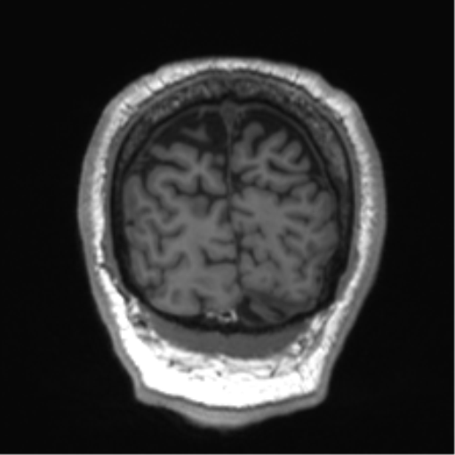 Normal brain MRI (non-focal epilepsy protocol) (Radiopaedia 53917-60040 Coronal T1 11).png