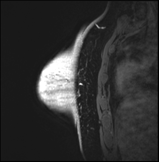 Normal breast MRI - dense breasts (Radiopaedia 80454-93850 I 150).jpg