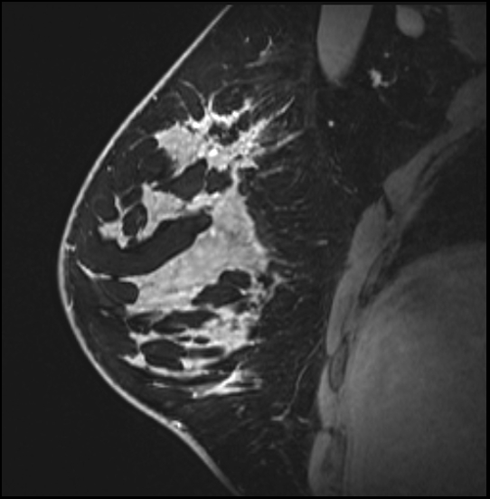 Normal breast MRI - dense breasts (Radiopaedia 80454-93850 I 69).jpg