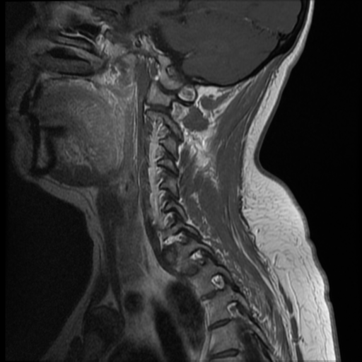 File:Normal cervical and thoracic spine MRI (Radiopaedia 35630-37156 Sagittal T1 C+ 10).png