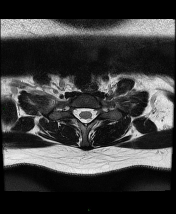 Normal cervical spine MRI (Radiopaedia 80146-93454 Axial T2 91).jpg