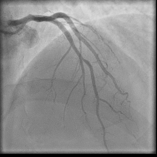 Normal coronary angiogram (DSA) (Radiopaedia 63081-71571 E 32).jpg