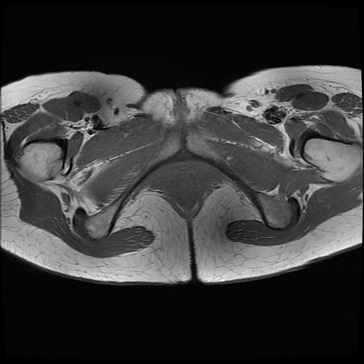File:Normal female pelvis MRI (retroverted uterus) (Radiopaedia 61832-69933 Axial T1 28).jpg