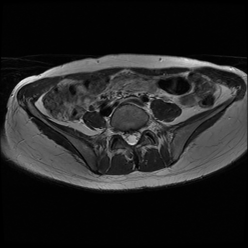 File:Normal female pelvis MRI (retroverted uterus) (Radiopaedia 61832-69933 Axial T2 4).jpg
