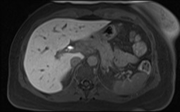 File:Normal hepatobiliary phase liver MRI (Radiopaedia 58968-66230 A 39).jpg