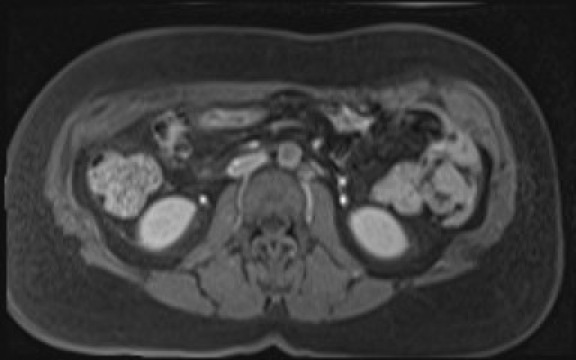 File:Normal hepatobiliary phase liver MRI (Radiopaedia 58968-66230 A 76).jpg