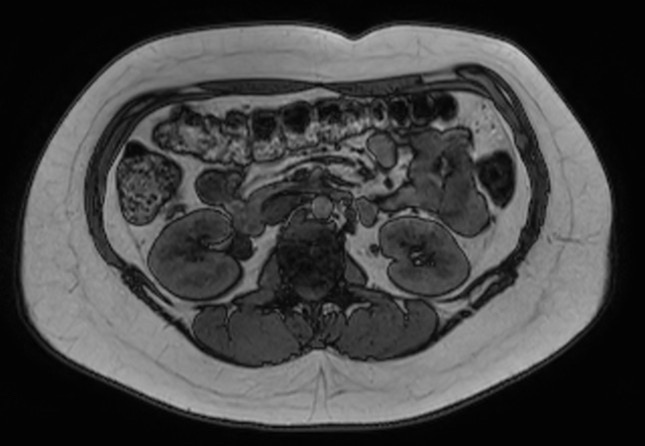 File:Normal liver MRI with Gadolinium (Radiopaedia 58913-66163 B 11).jpg