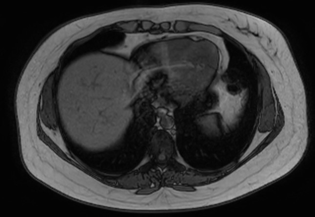 File:Normal liver MRI with Gadolinium (Radiopaedia 58913-66163 B 29).jpg