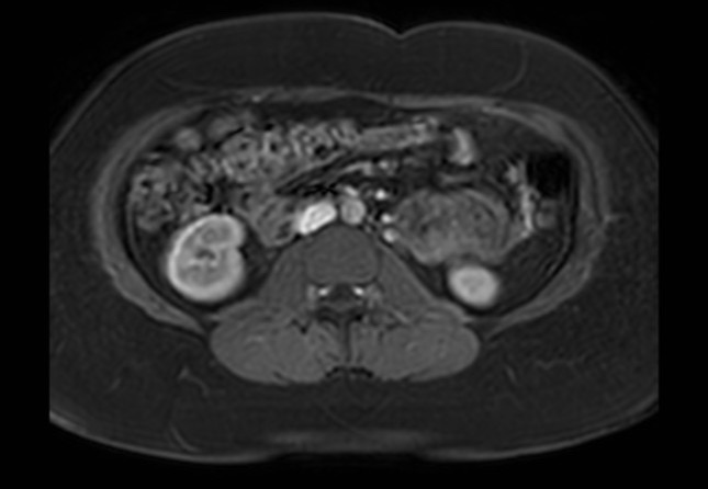 Normal liver MRI with Gadolinium (Radiopaedia 58913-66163 J 6).jpg