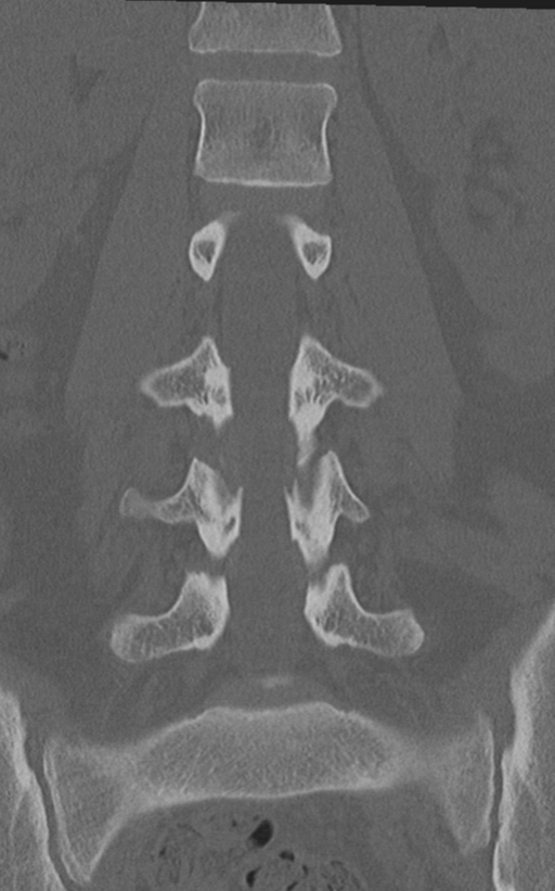 Normal lumbar spine CT (Radiopaedia 46533-50986 Coronal bone window 40).png