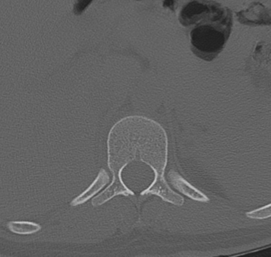 File:Normal lumbosacral CT (Radiopaedia 37923-39867 Axial bone window 11).png