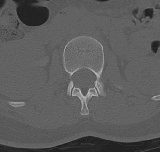 File:Normal lumbosacral CT (Radiopaedia 37923-39867 Axial bone window 38).png