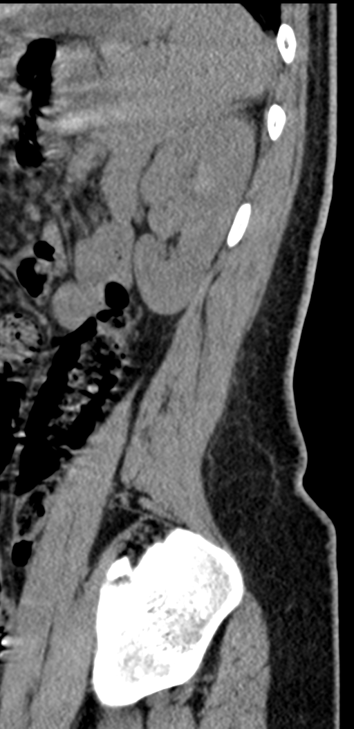 Normal lumbosacral CT (Radiopaedia 37923-39867 E 19).png