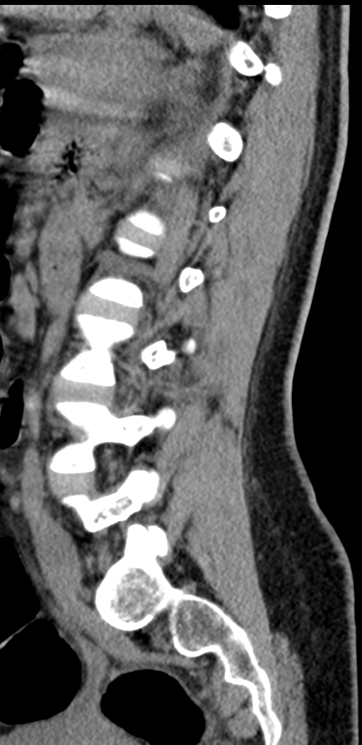 Normal lumbosacral CT (Radiopaedia 37923-39867 E 41).png