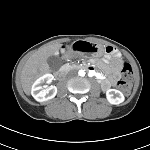File:Normal multiphase CT liver (Radiopaedia 38026-39996 B 42).jpg