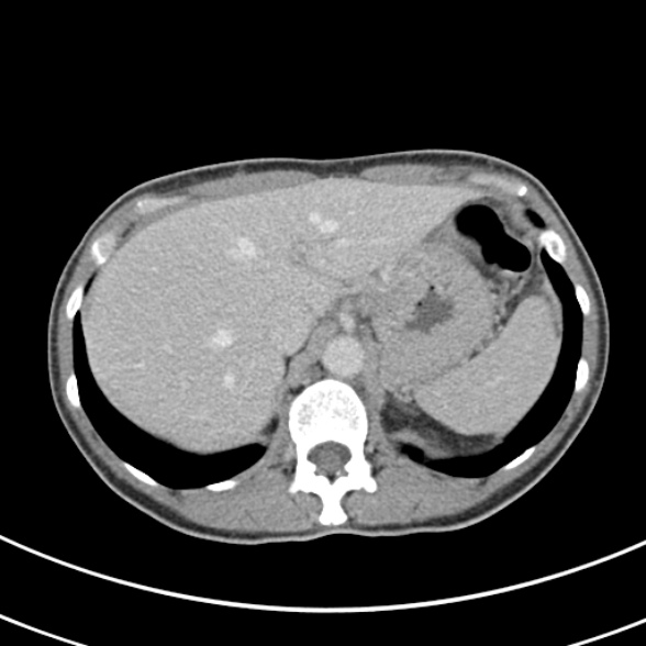 File:Normal multiphase CT liver (Radiopaedia 38026-39996 C 14).jpg