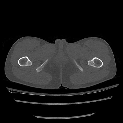 Normal pelvis CT (Radiopaedia 51471-57236 Axial bone window 102).jpg