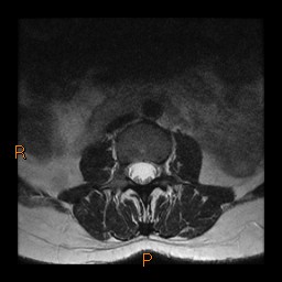 File:Normal spine MRI (Radiopaedia 77323-89408 Axial T2 4).jpg