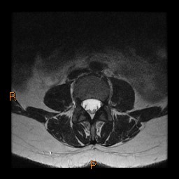 File:Normal spine MRI (Radiopaedia 77323-89408 Axial T2 9).jpg