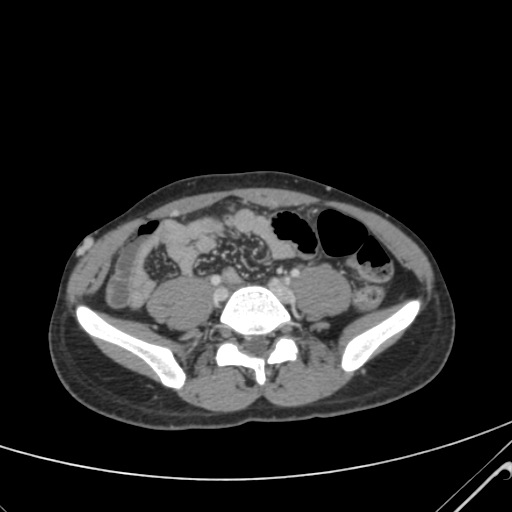 File:Nutmeg liver- Budd-Chiari syndrome (Radiopaedia 46234-50635 B 49).png