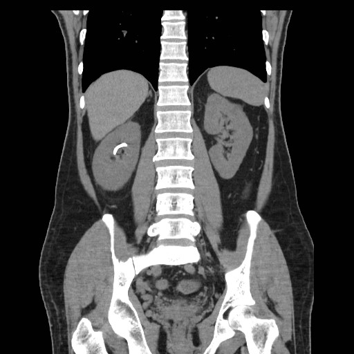 File:Obstructed kidney with perinephric urinoma (Radiopaedia 26889-27067 Coronal non-contrast 18).jpg